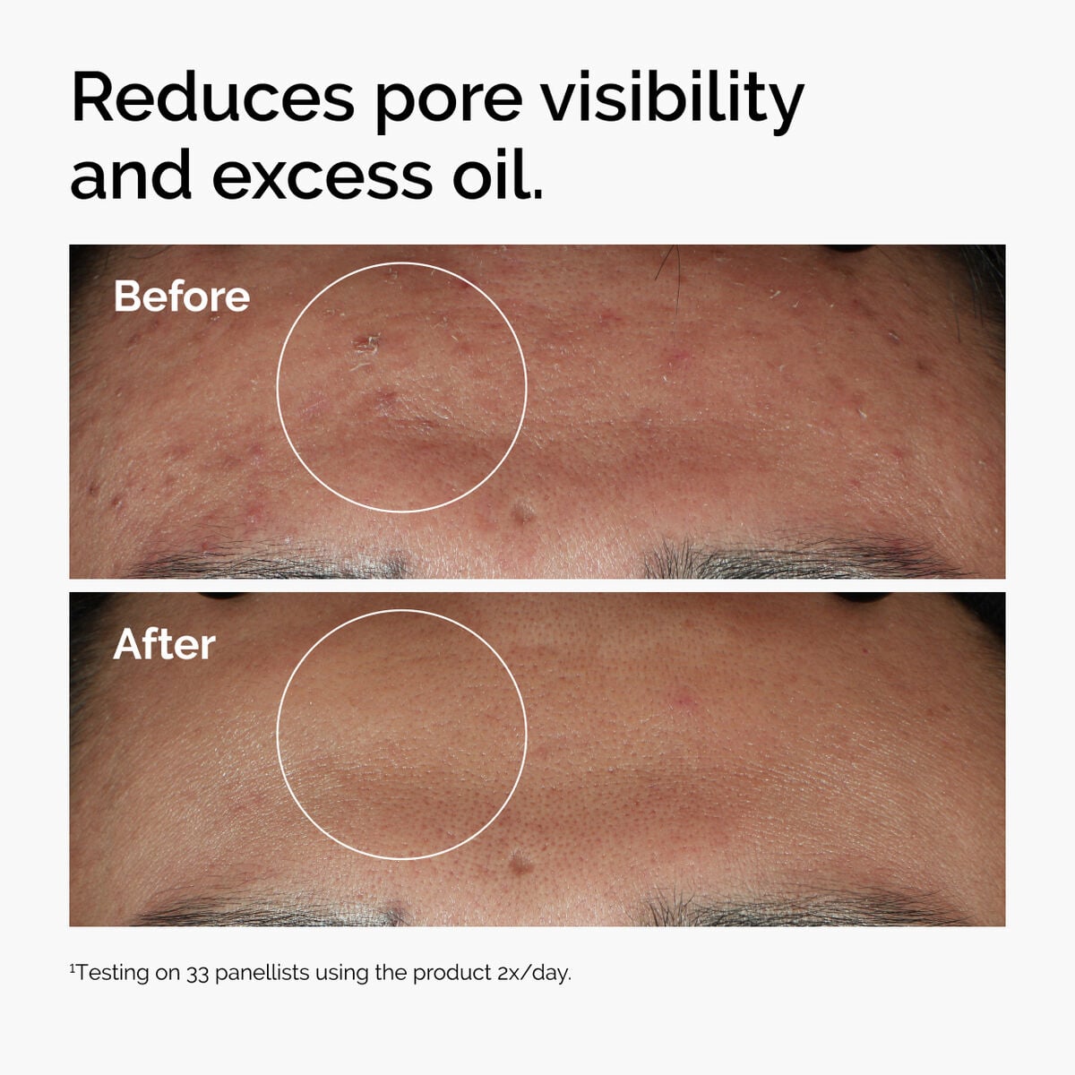 niacinamide-10-zinc-1-e9 ord-niacinamide-zinc-blemish-serum-before-after-pores.jpg