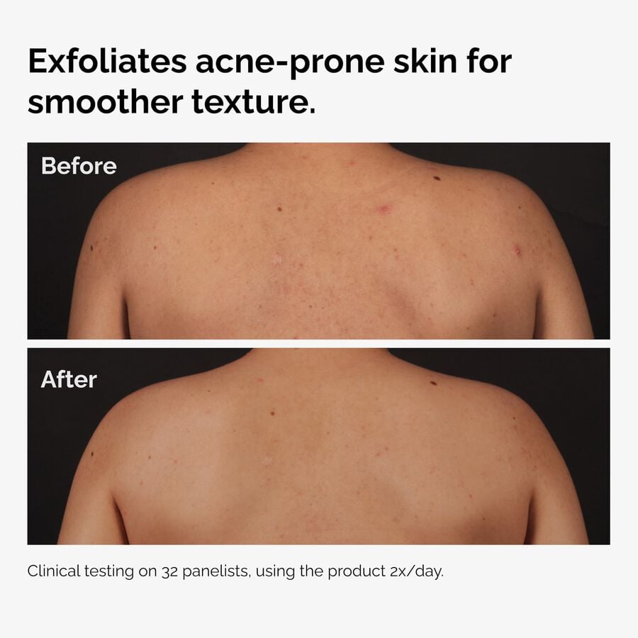 the-body-care-collection-f7 ord-salicylic-acid-body-serum-before-after-graphic-NA.jpg
